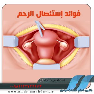 إزالة الرحم من خلال المهبل