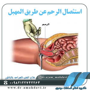 استئصال الرحم عن طریق المهبل