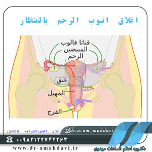 اغلاق انبوب الرحم بالمنظار     